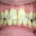 インビザライン治療 症例