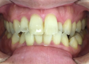 インビザライン治療　症例