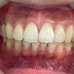 インビザライン治療 症例