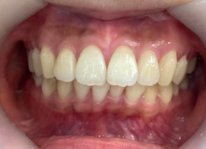 インビザライン治療　症例