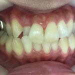 インビザライン治療 症例