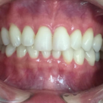 インビザラインGO治療 症例