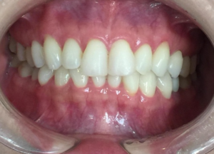 インビザラインGO治療　症例