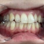 インビザライン治療　症例