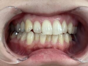 インビザライン治療　症例