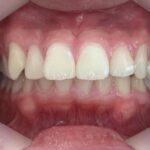 インビザライン治療　症例