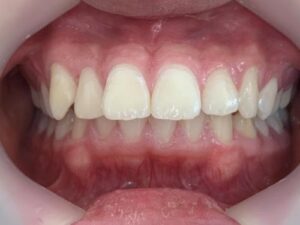 インビザライン治療　症例