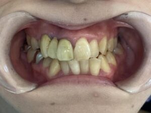 インビザライン治療　症例