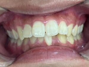 インビザライン治療　症例