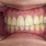 インビザライン治療　症例