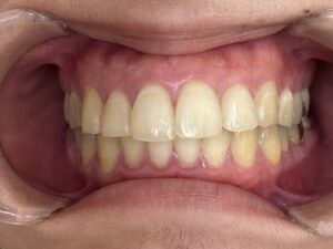 インビザライン治療　症例