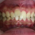 インビザライン治療　症例