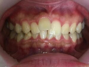 インビザライン治療　症例