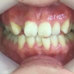 インビザライン治療　症例