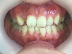 インビザライン治療　症例
