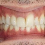 インビザライン治療　症例