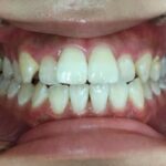 インビザライン治療 症例