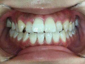 インビザライン治療　症例