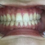 インビザラインGO・セラミック治療 症例