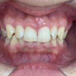 インビザライン治療 症例