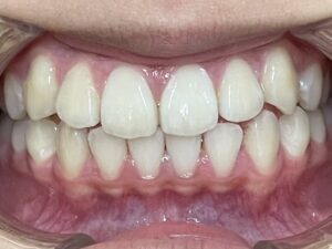 小児矯正　症例