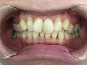 インビザラインGo治療　症例