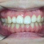 インビザラインGO治療　症例