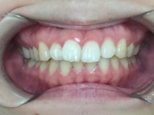 インビザラインGO治療　症例