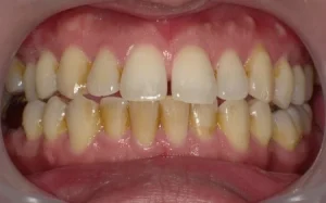 クリーニング　症例