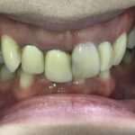 インビザライン矯正と自費補綴 症例