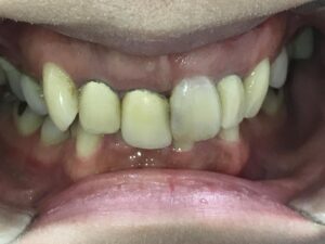 インビザライン矯正と自費補綴　症例