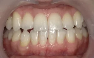 ホワイトニング　症例