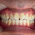 インビザライン治療GO 症例