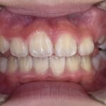 小児矯正　症例