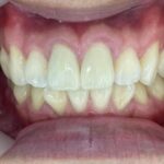 インビザライン治療 症例