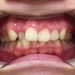 インビザライン治療　症例