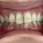 インビザライン治療 症例