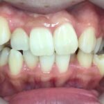 インビザライン治療 症例