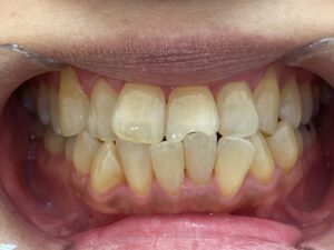 インビザライン治療　症例