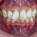 インビザライン治療GO 症例