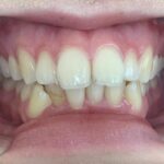 インビザライン治療 症例