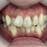 インビザライン治療 症例