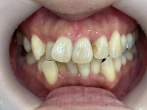 インビザライン治療　症例