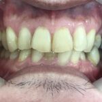 インビザライン治療 症例