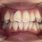 インビザライン治療　症例