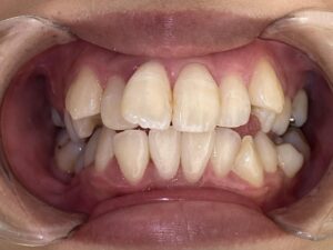 インビザライン治療　症例