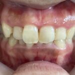 インビザライン治療 症例