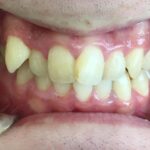 インビザライン治療　症例