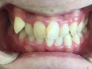 インビザライン治療　症例