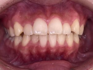 インビザライン治療　症例